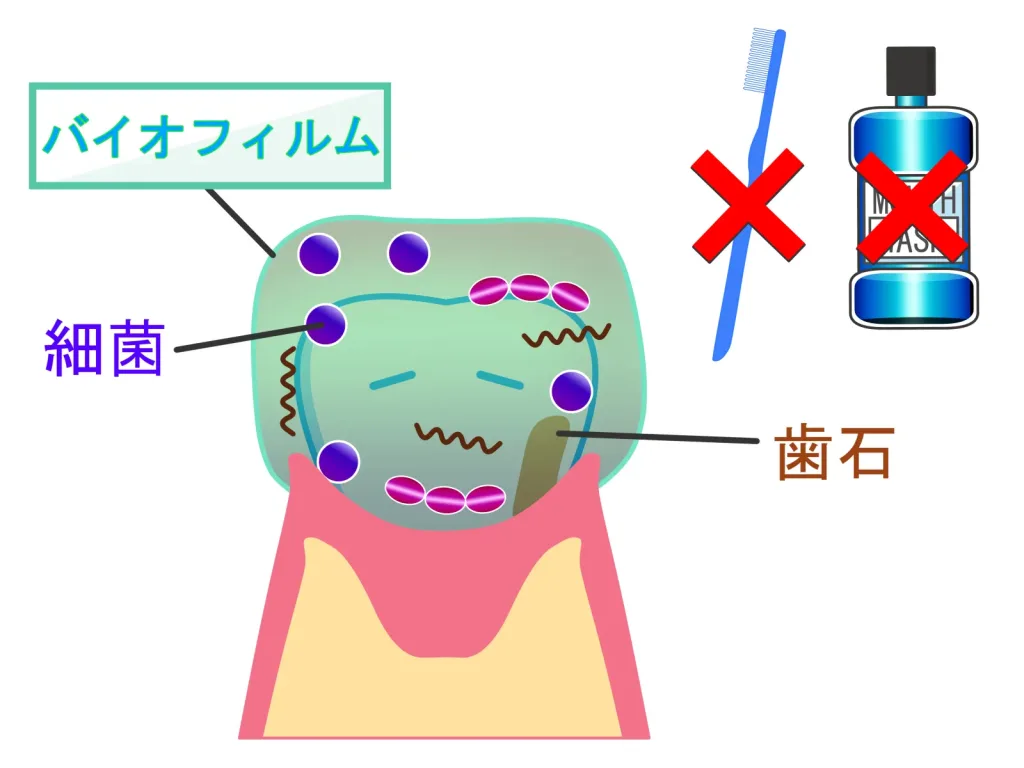 歯のバイオフィルムの画像