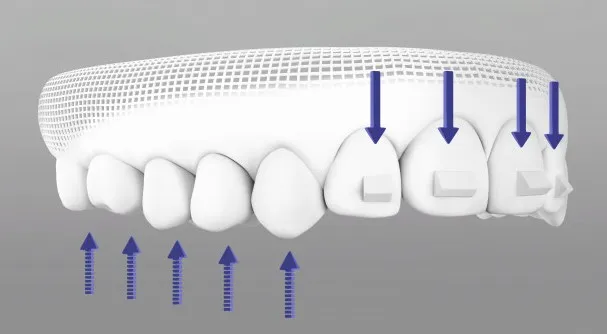 インビザラインマルチトゥース挺出用アタッチメント