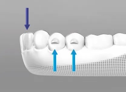 インビザライン過蓋咬合用最適アタッチメント