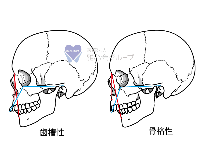 歯槽性・骨格性