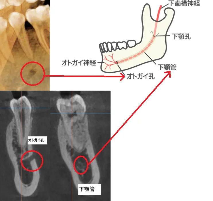 オトガイ孔と下顎管