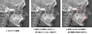 セファロ分析流れ