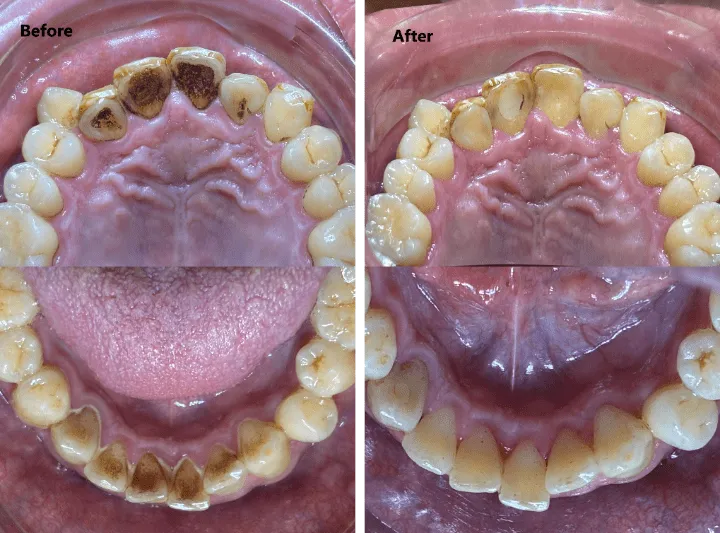 クリーニングのbeforeafter