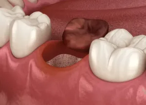 ドライソケット