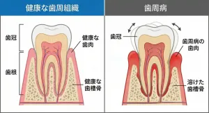 健康な歯と歯周病の歯