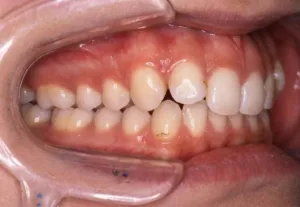 口蓋側傾斜ディープバイト