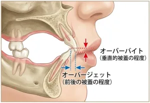 オーバーバイトオーバージェット